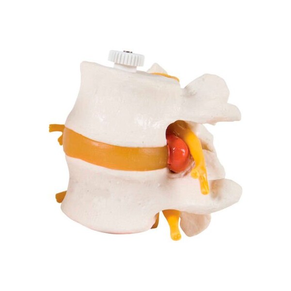 Fabrication Enterprises 3B Anatomical Model - 2 Lumbar Vertebrae with Prolapsed Disc, Flexibly Mounted 984665 - main